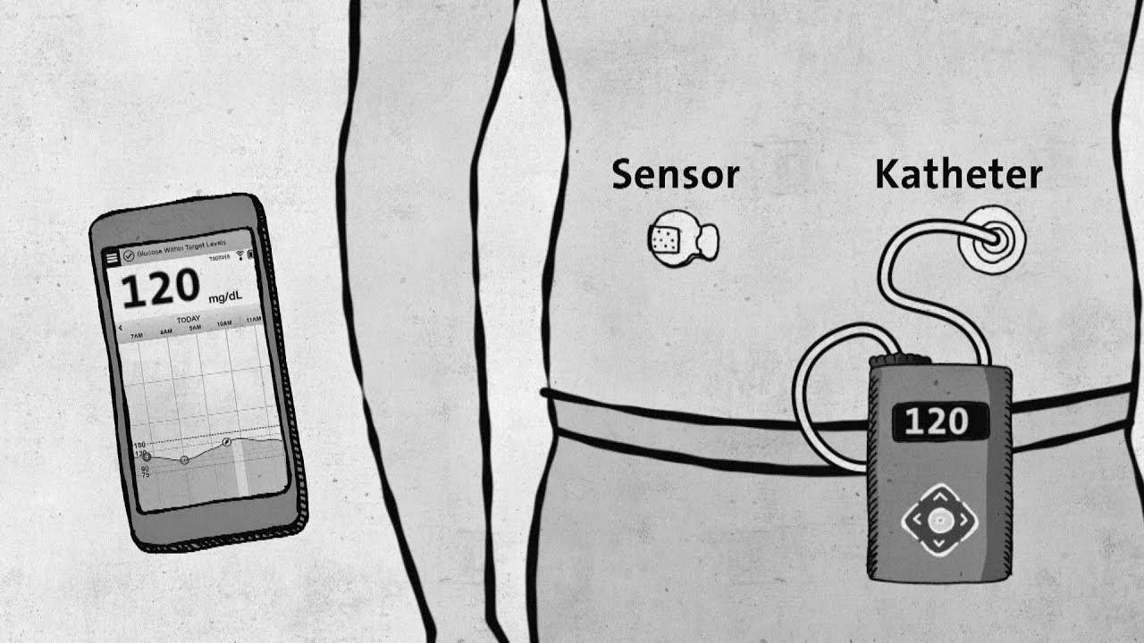 {Type|Sort|Kind} 1 diabetes – {modern|trendy|fashionable} {technology|know-how|expertise} {without|with out} approval – good to know